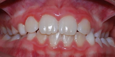 Posterior Crossbite