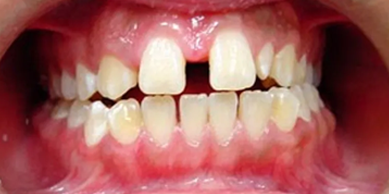 Large Diastema